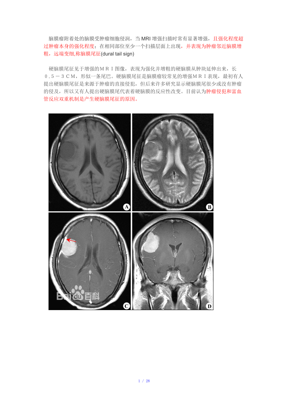 脑膜尾征--脑膜瘤图片参考模板.doc_第1页