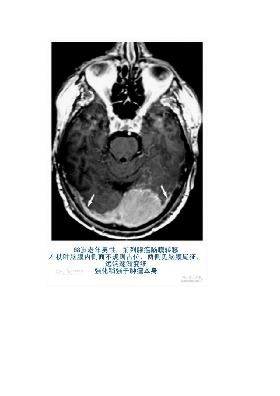 脑膜尾征--脑膜瘤图片参考模板.doc_第2页