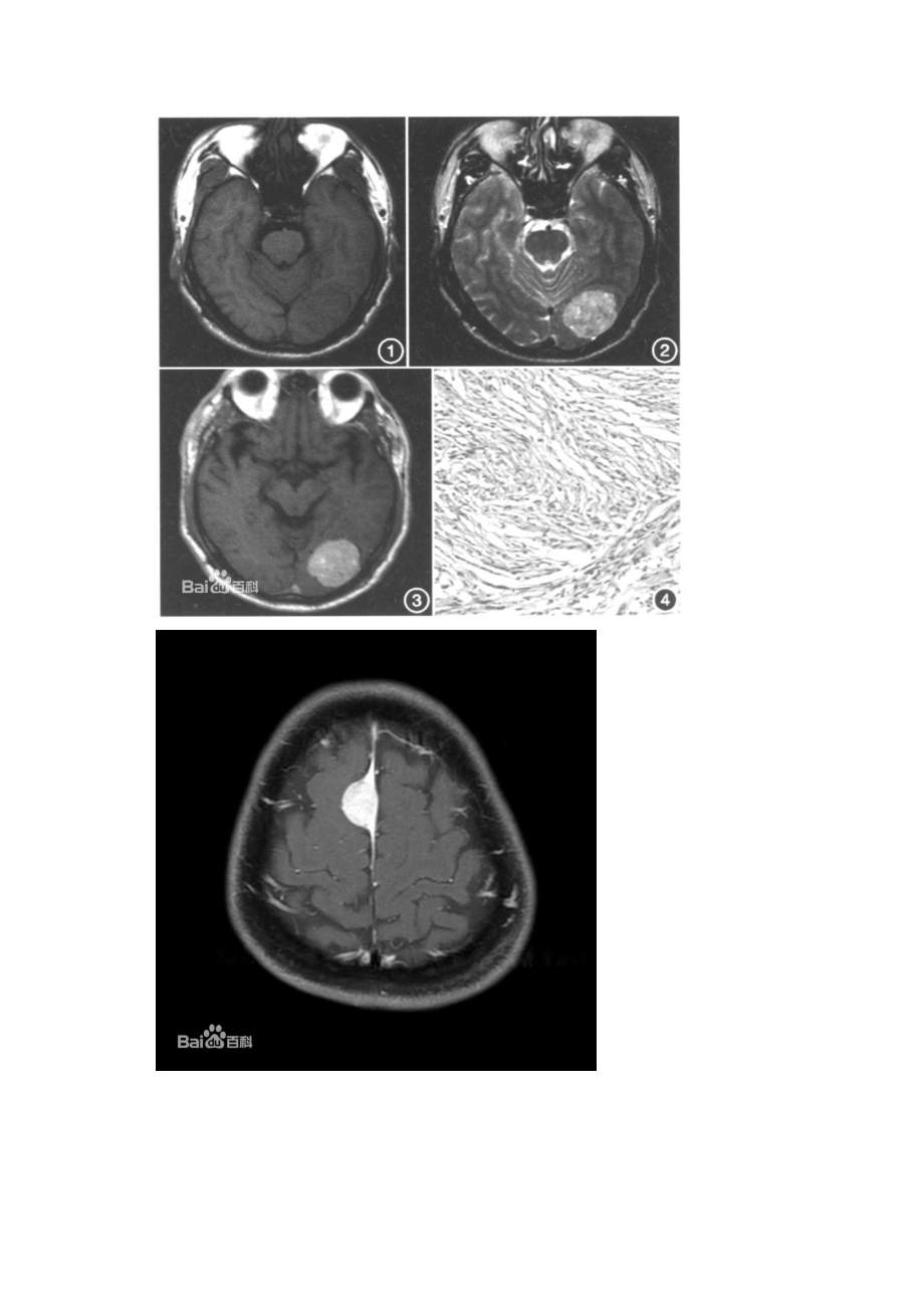 脑膜尾征--脑膜瘤图片参考模板.doc_第3页