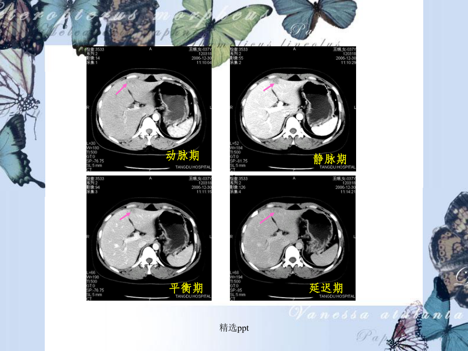 肝脏镰状韧带旁假.ppt_第1页