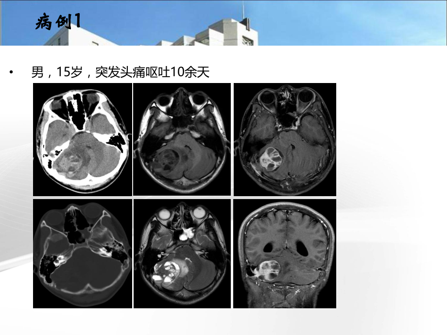 业务]颅骨肿瘤影像学表现.ppt_第2页