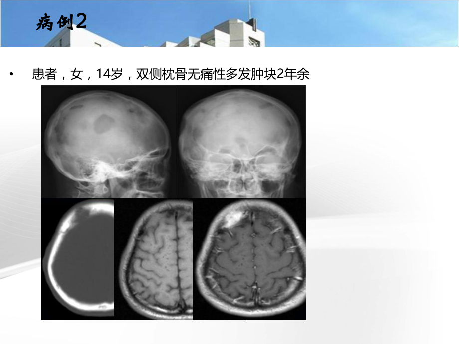 业务]颅骨肿瘤影像学表现.ppt_第3页